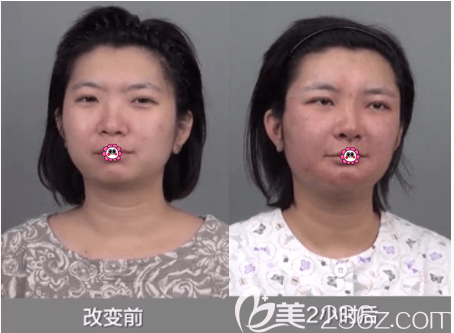 在北京上上前做自體脂肪填充下巴術(shù)前與手術(shù)兩個(gè)小時(shí)后對(duì)比效果
