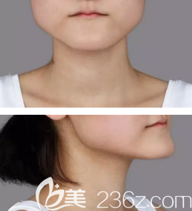 雙鄂手術(shù)術(shù)前照片 雙鄂手術(shù)術(shù)前照片