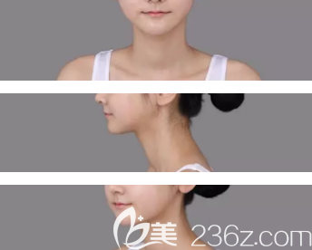 雙鄂矯正術(shù)貴嗎？我5月做的上下顎矯正手術(shù)總共花費(fèi)8萬多+矯正牙齒的2萬一共是10萬多