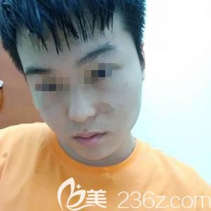 在石家莊天伊美做光子嫩膚術后面部微腫 在石家莊天伊美做光子嫩膚術后面部微腫