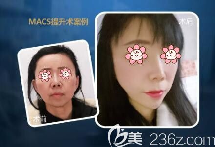 MACS提拉術(shù)真人前后效果對(duì)比