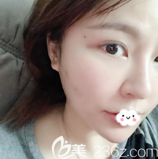 剛在廣州紫馨做完線雕提升術(shù)后3天效果圖 剛在廣州紫馨做完線雕提升術(shù)后3天效果圖