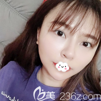 面部線雕提升術(shù)后5天恢復(fù)效果圖 面部線雕提升術(shù)后5天恢復(fù)效果圖