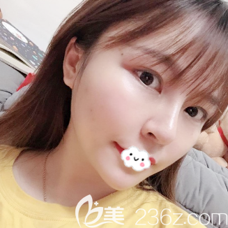 廣州紫馨面部線雕術(shù)后7天恢復(fù)圖片 廣州紫馨面部線雕術(shù)后7天恢復(fù)圖片