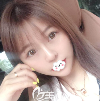 廣州紫馨面部線雕一個(gè)月恢復(fù)過程圖片 廣州紫馨面部線雕一個(gè)月恢復(fù)過程圖片