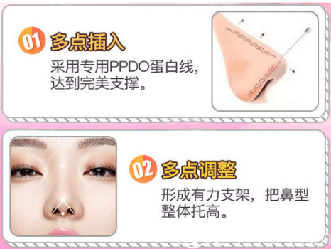 廣州紫馨于曉強(qiáng)線雕隆鼻手術(shù)特點 廣州紫馨于曉強(qiáng)線雕隆鼻手術(shù)特點