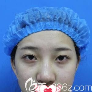在石家莊天伊美做雙眼皮術前是內雙眼皮 在石家莊天伊美做雙眼皮術前是內雙眼皮
