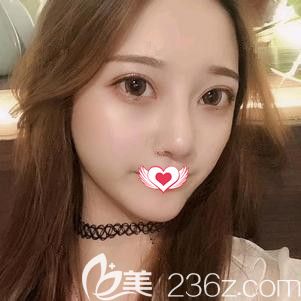 內(nèi)雙小眼睛的我找張柏松做完韓式切開雙眼皮術(shù)后覺得效果自然無痕 所以將石家莊天伊美醫(yī)療美容醫(yī)院地址和眼部整形價格表奉上