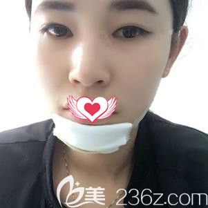 <!--<i data=20240703-sp></i>-->醫(yī)生為我剛做完硅膠點(diǎn)下術(shù)后下巴腫脹 <!--<i data=20240703-sp></i>-->醫(yī)生為我剛做完硅膠點(diǎn)下術(shù)后下巴腫脹