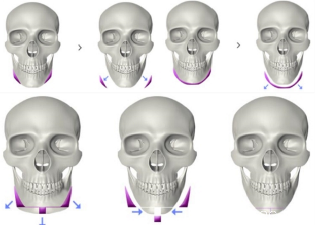 韓國(guó)H醫(yī)院下頜角整形手術(shù)方法 韓國(guó)H醫(yī)院下頜角整形手術(shù)方法
