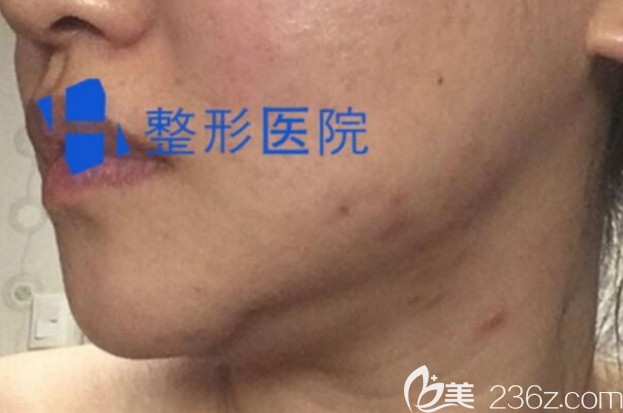 韓國(guó)H整形下頜角修復(fù)術(shù)前照片 韓國(guó)H整形下頜角修復(fù)術(shù)前照片