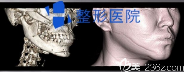 韓國(guó)H整形下頜角修復(fù)術(shù)前CT圖片 韓國(guó)H整形下頜角修復(fù)術(shù)前CT圖片