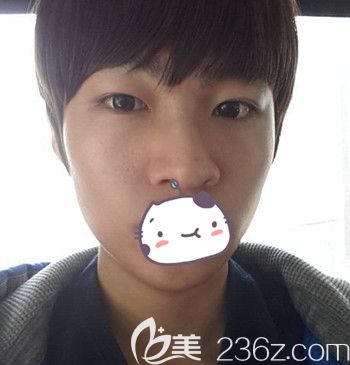 在韓國JJ洪鎮(zhèn)柱整形外科做面部輪廓+眼鼻整形手術(shù)前 在韓國JJ洪鎮(zhèn)柱整形外科做面部輪廓+眼鼻整形手術(shù)前