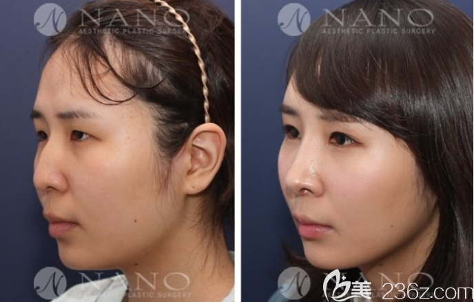 公開韓國Nano整形外科趙重衍隆鼻案例，價格800萬韓幣起