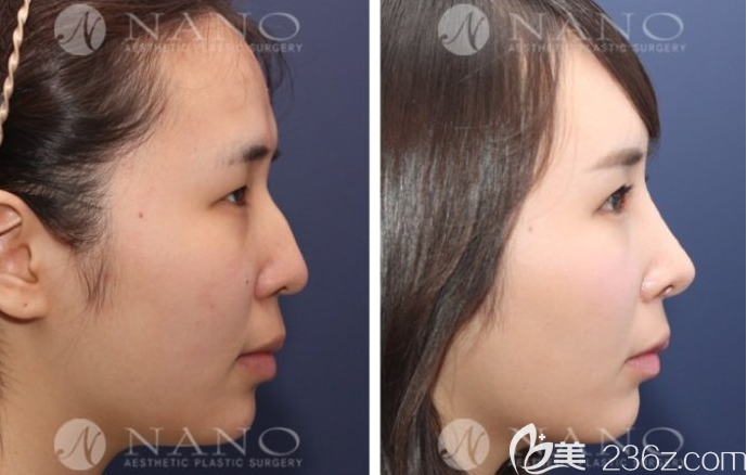 公開韓國Nano整形外科趙重衍隆鼻案例 公開韓國Nano整形外科趙重衍隆鼻案例