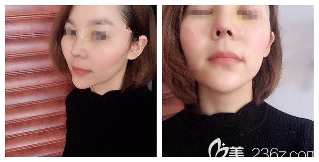 找顧陸健醫(yī)生做半肋軟骨隆鼻術(shù)后6天拆線恢復(fù) 找顧陸健醫(yī)生做半肋軟骨隆鼻術(shù)后6天拆線恢復(fù)