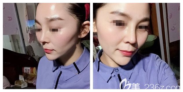 分享做了半肋軟骨隆鼻術(shù)后半個(gè)月恢復(fù) 分享做了半肋軟骨隆鼻術(shù)后半個(gè)月恢復(fù)