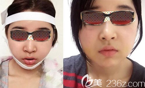 韓國釜山哈娜爾整形金成浩顴骨內(nèi)推術(shù)后6天恢復(fù)效果圖 韓國釜山哈娜爾整形金成浩顴骨內(nèi)推術(shù)后6天恢復(fù)效果圖