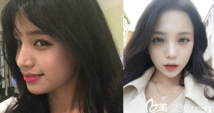 歪鼻在韓國高諾鼻CONOPI整形鄭太英（丁泰榮）做了隆鼻矯正混血風來了