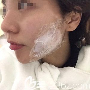 涂抹過(guò)麻醉膏后注射瘦臉 涂抹過(guò)麻醉膏后注射瘦臉