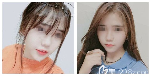 3500元起的蘭州和6500元起的美國，糾結(jié)后我在揚(yáng)州美貝爾注射了進(jìn)口瘦臉改善咬肌大國字臉