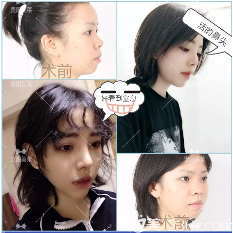 貴陽美萊梁潔隆鼻怎么樣