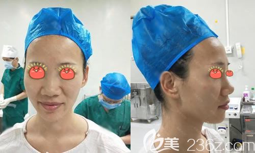 做鼻綜合隆鼻手術(shù)前照片 做鼻綜合隆鼻手術(shù)前照片