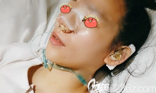 剛做完假體和耳軟骨鼻綜合圖片 剛做完假體和耳軟骨鼻綜合圖片