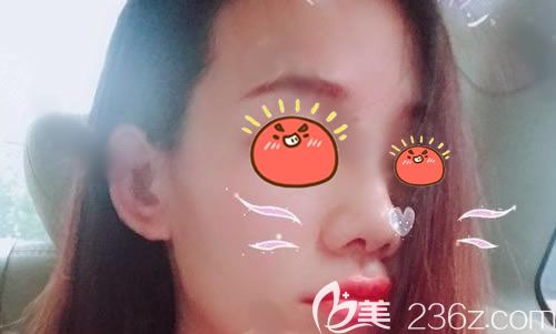 杭州薇琳鼻綜合隆鼻<span style= 杭州薇琳鼻綜合隆鼻<span style=