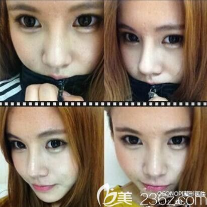 韓國高諾鼻CONOPI整形鄭太英隆鼻+脂肪填充后再也沒人把我歸為丑女一族