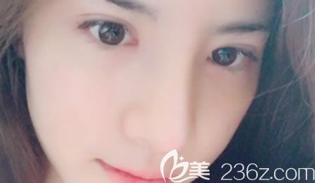 杭州薇琳吳學(xué)軍隆鼻手術(shù)<span style=