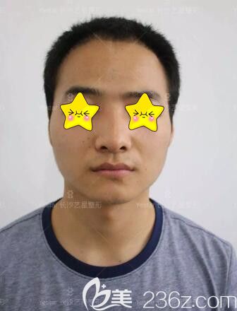 做自體脂肪填充面部術(shù)前照 做自體脂肪填充面部術(shù)前照