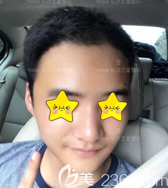 做完自體脂肪填充面部術(shù)后第4天效果照 做完自體脂肪填充面部術(shù)后第4天效果照