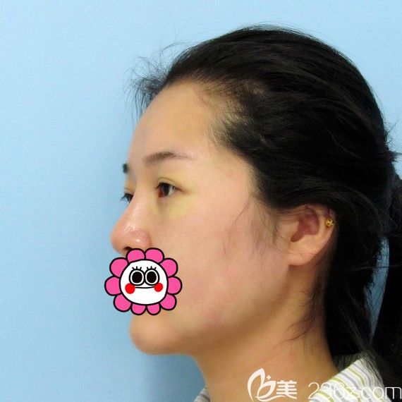 哈爾濱索菲內(nèi)路祛眼袋后第二天 哈爾濱索菲內(nèi)路祛眼袋后第二天