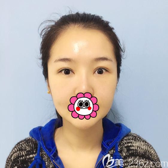 哈爾濱索菲內(nèi)路祛眼袋恢復半個月后 哈爾濱索菲內(nèi)路祛眼袋恢復半個月后