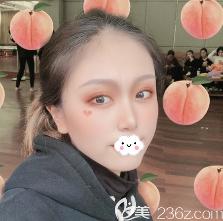 鼻綜合隆鼻術(shù)后半個(gè)月恢復(fù)效果圖 鼻綜合隆鼻術(shù)后半個(gè)月恢復(fù)效果圖