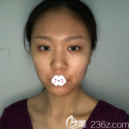 在東莞維多利亞做鼻子術(shù)前照片 在東莞維多利亞做鼻子術(shù)前照片