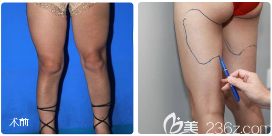 在廣州中家醫(yī)家庭醫(yī)生做大腿吸脂術(shù)前照片 在廣州中家醫(yī)家庭醫(yī)生做大腿吸脂術(shù)前照片