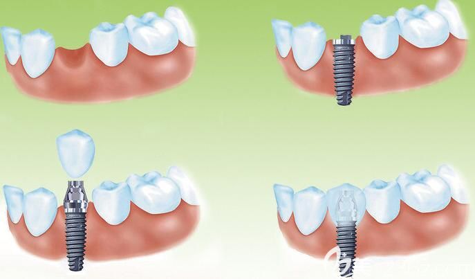 上海億大口腔蘇濤醫(yī)生介紹種植牙過程 上海億大口腔蘇濤醫(yī)生介紹種植牙過程