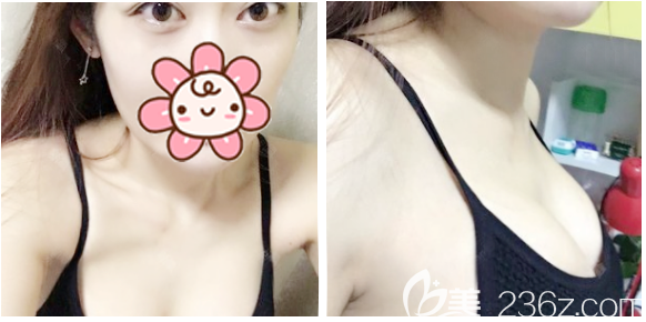 曼托假體隆胸術(shù)后20天拆線效果