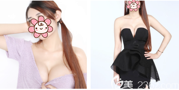 感覺這次找深圳非凡王永祥做曼托假體隆胸的錢沒白花,因為無論是效果還是手感都很棒