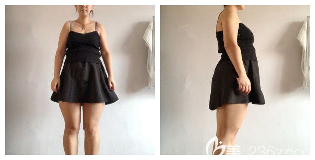 面診南京華韓奇致術(shù)前小肚腩大粗腿 面診南京華韓奇致術(shù)前小肚腩大粗腿