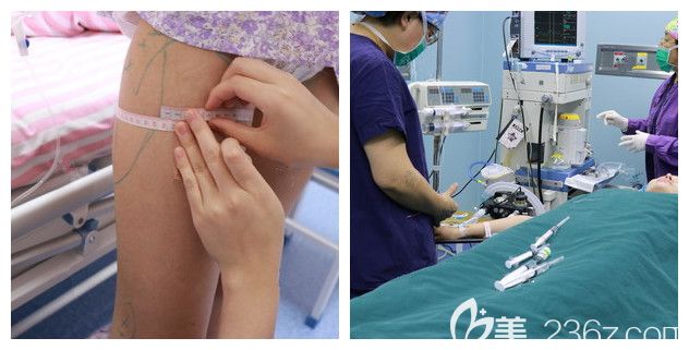 南京華韓奇致醫(yī)生面診建議水動力吸脂 南京華韓奇致醫(yī)生面診建議水動力吸脂