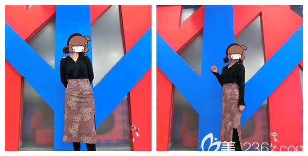 分享做水動力吸脂術(shù)后一個月效果 分享做水動力吸脂術(shù)后一個月效果