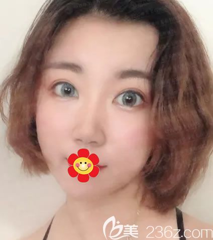 紹興做鼻子哪個醫(yī)院好,我選擇紹興維美康樂做了假體+耳軟骨綜合隆鼻,成功擺脫“扁塌鼻”