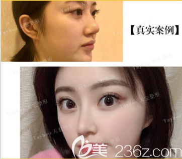 距離我在醫(yī)療美容門診部做全切雙眼皮已經(jīng)過去有半年的時(shí)間了，我來給大家看看照片