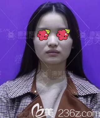 做肋軟骨復(fù)合隆鼻術(shù)前照 做肋軟骨復(fù)合隆鼻術(shù)前照