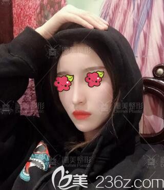 做完肋軟骨復(fù)合隆鼻術(shù)后1個(gè)月時(shí)的恢復(fù)程度 做完肋軟骨復(fù)合隆鼻術(shù)后1個(gè)月時(shí)的恢復(fù)程度