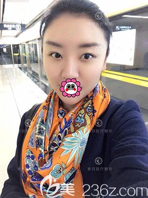 看完我在哈爾濱索菲做的自體脂肪填充面部后，你有沒有想做的沖動呢？