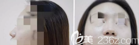 <!--<i data=20240703-sp></i>-->醫(yī)療美容門診部術(shù)前隆鼻側(cè)面和正面照片 <!--<i data=20240703-sp></i>-->醫(yī)療美容門診部術(shù)前隆鼻側(cè)面和正面照片